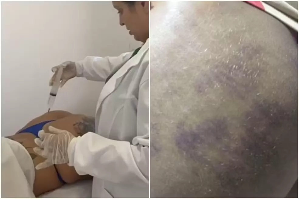 Mulher é presa em João Pessoa suspeita de se passar por médica e realizar procedimentos estéticos de risco; justiça concede liberdade